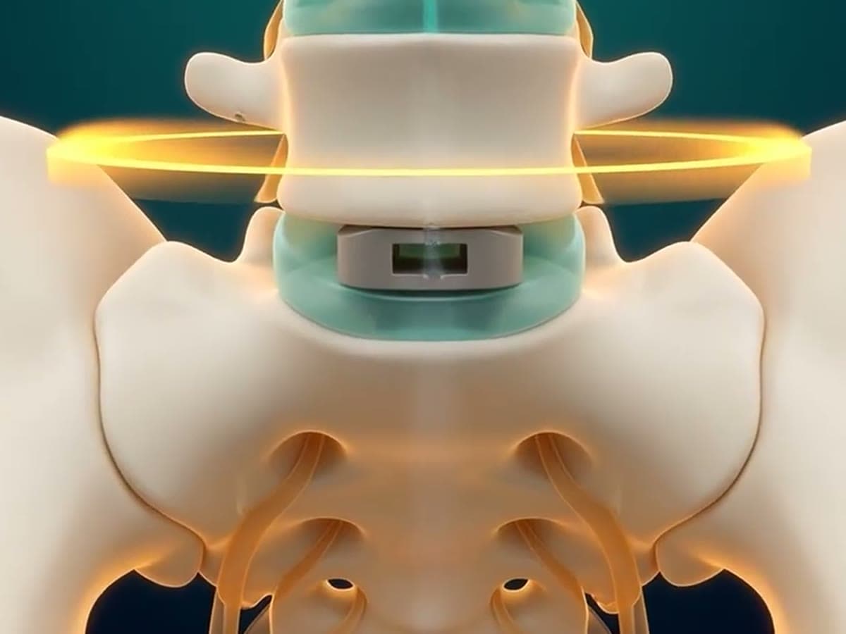 Illustration of a fusion cage placed from the front at the base of the spine