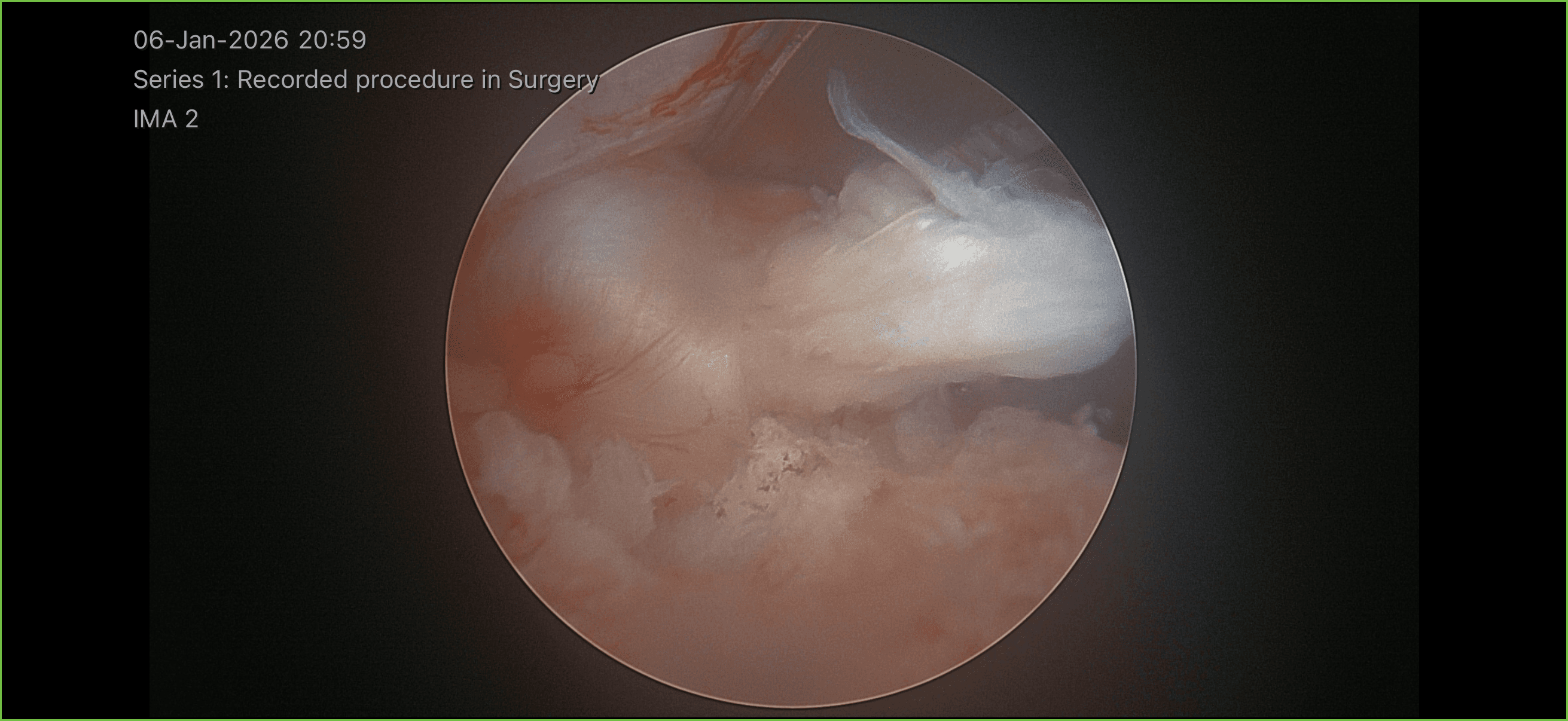 Endoscopic view inside the spinal canal showing the disc being removed during biportal endoscopic spine surgery