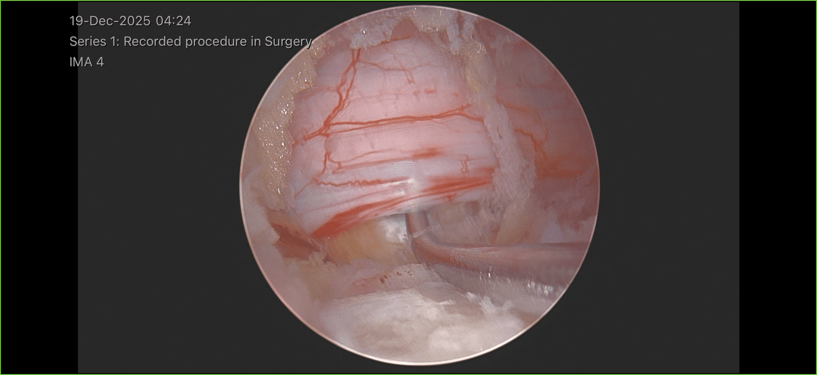 Endoscopic view inside the spinal canal showing the spinal nerve during biportal endoscopic spine surgery