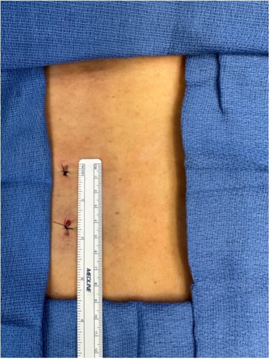 Two small incisions used in biportal endoscopic spine surgery, showing the minimal size of the portals